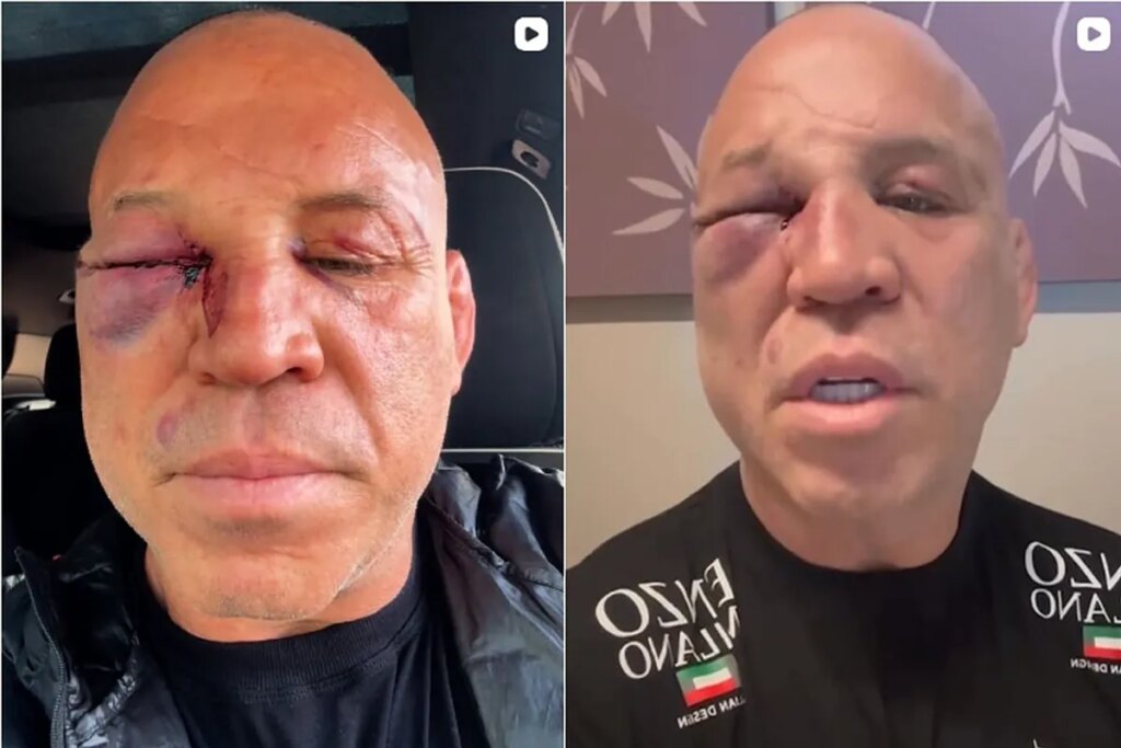 Wanderlei Silva ends up with a disfigured face after being treacherously attacked in a brawl in the ring